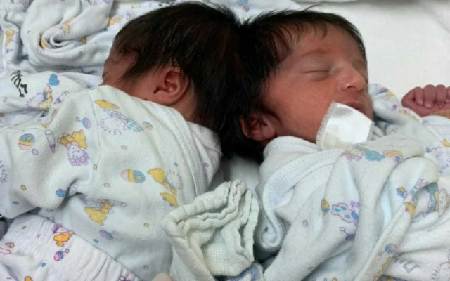 Conjoined twins, photographed before they were separated at Soroka University Medical Center in Beersheba. (Photo courtesy, Soroka University Medical Center)