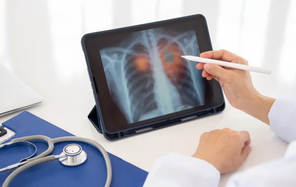 Israeli researchers develop blood test for early lung cancer detection