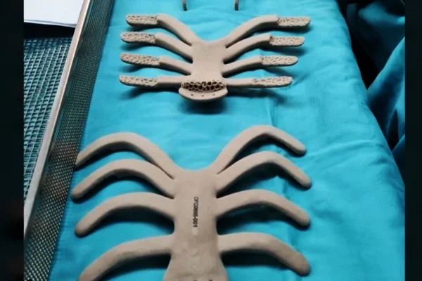 Israeli surgeons perform first complete rib cage replacement with 3D-printed implant